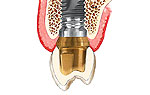 implant&aacute;ci&oacute;s fogp&oacute;tl&aacute;s