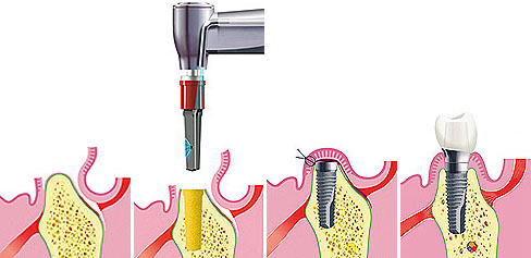 fogbe&uuml;ltet&eacute;s, implant&aacute;ci&oacute;